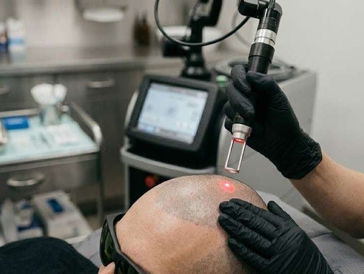 What makes Nd:YAG laser so effective at removing SMP pigment?