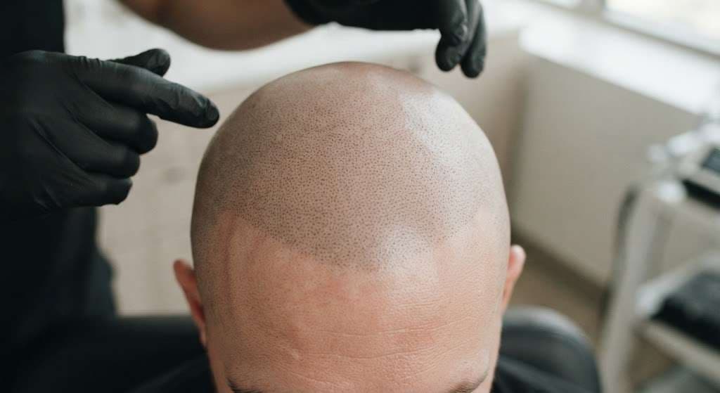 What actually happens to your scalp after shaved SMP, day by day