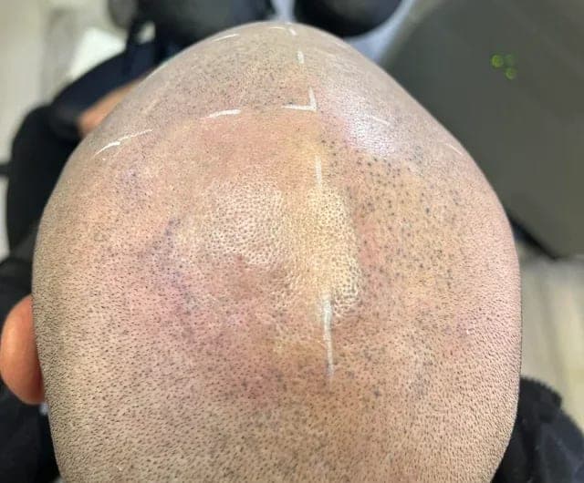5 things laser removal can actually fix on a bad SMP hairline
