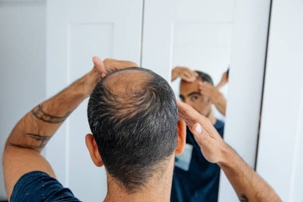 SMP vs. Hair Transplants: Which Hair Loss Solution Is Right for You?
