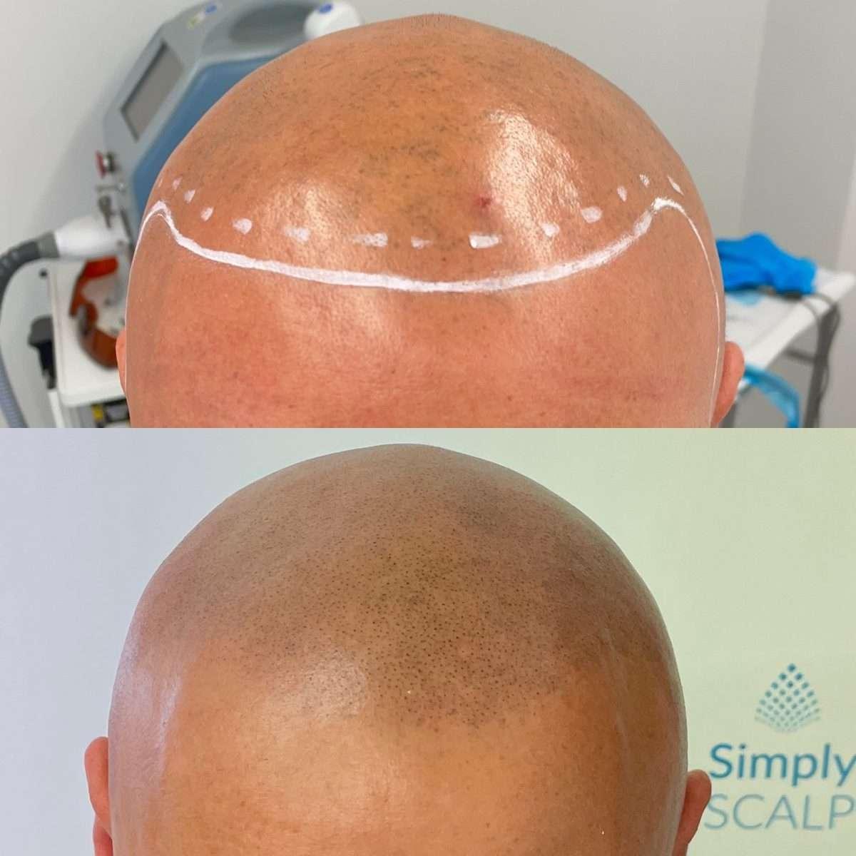 Scalp micropigmentation hairline result on a Simply Scalp client