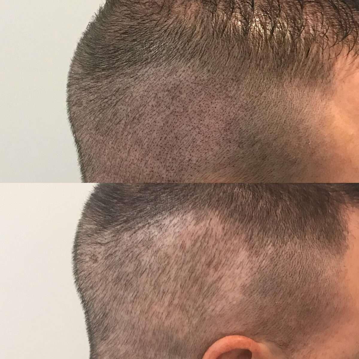 Completed scalp micropigmentation treatment at Simply Scalp