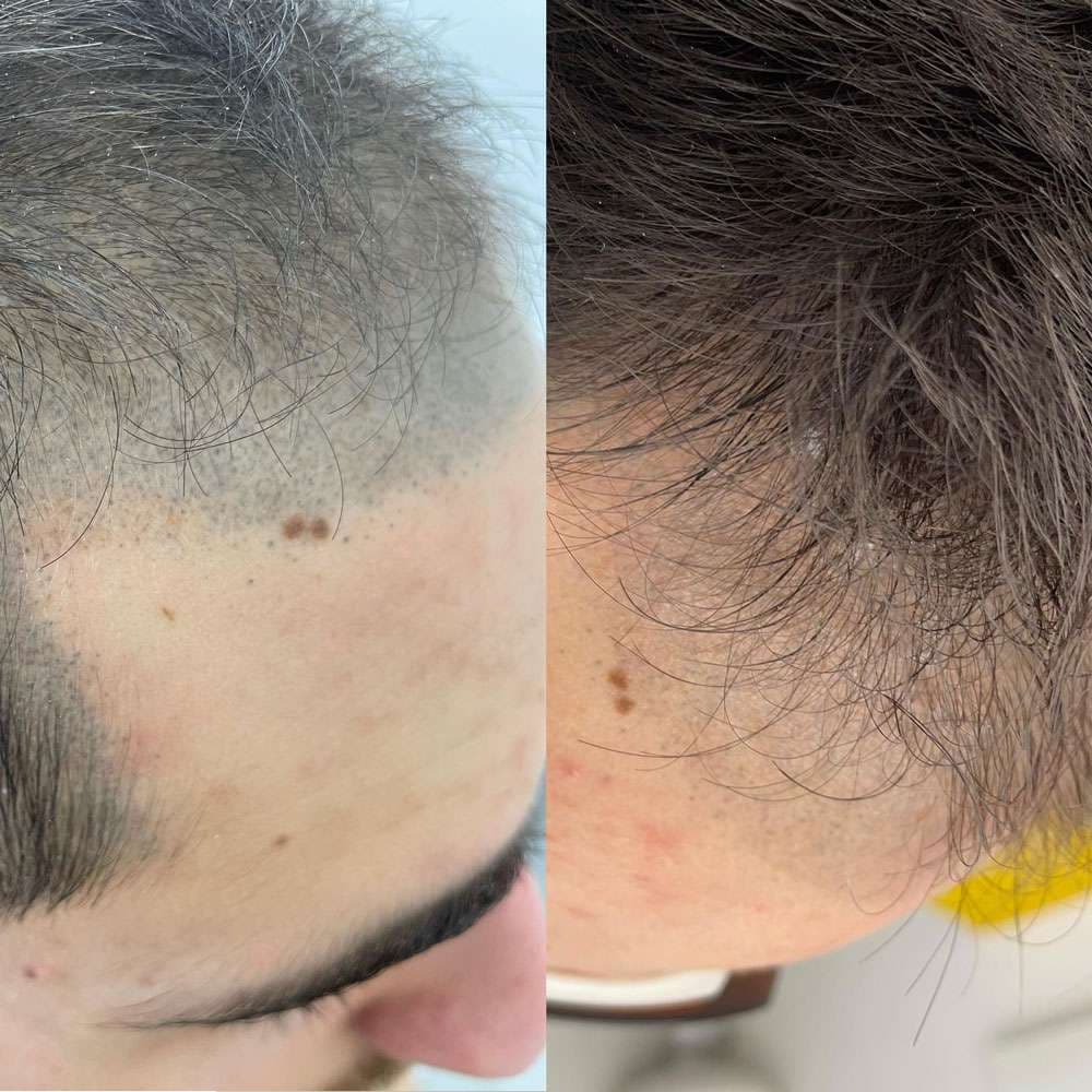 SMP removal treatment in progress at Simply Scalp