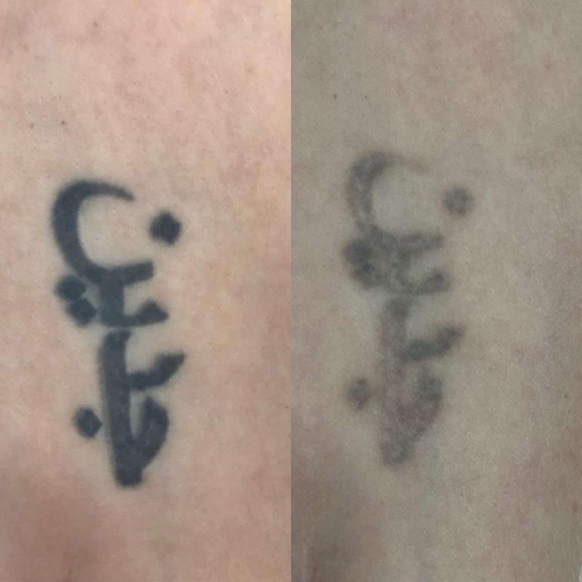 Tattoo removal result on a Simply Scalp client