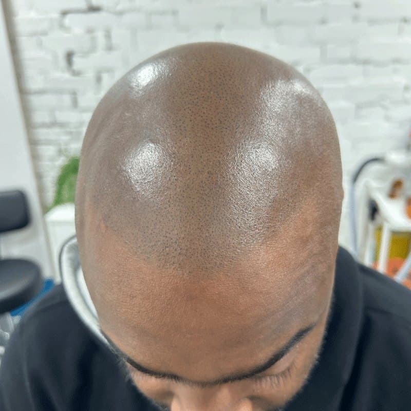 Top-down view of a man's shaved head showing evenly spaced dark pigment dots across the scalp, in a bright studio.