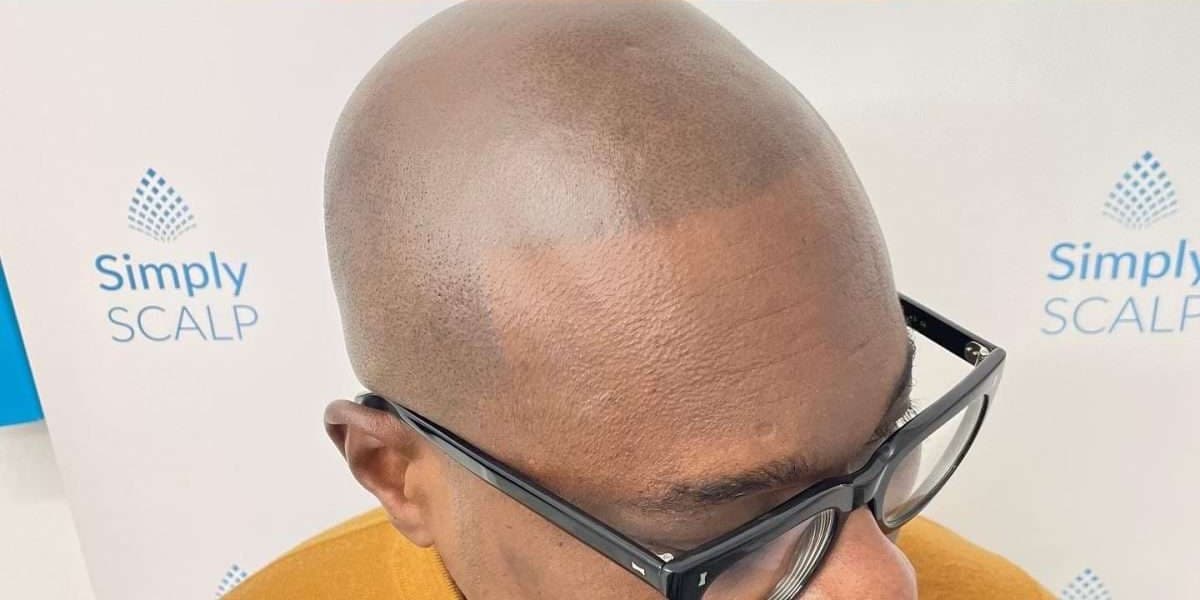 Completed natural hairline after scalp micropigmentation