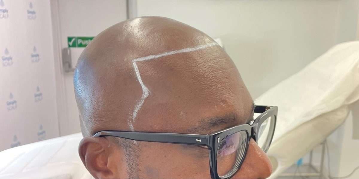 Hairline design drawn on before scalp micropigmentation