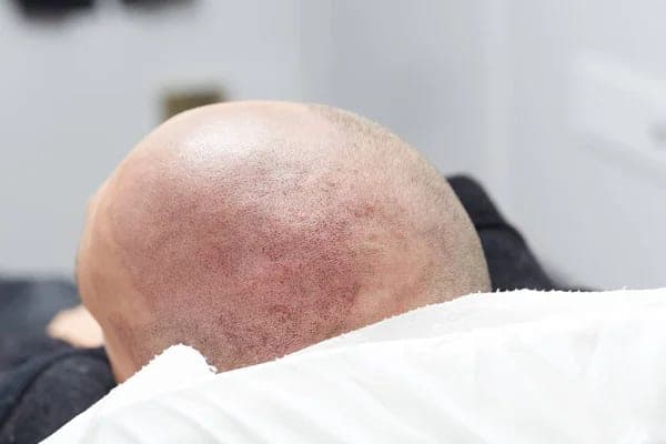 How much scalp micropigmentation pain should you actually expect