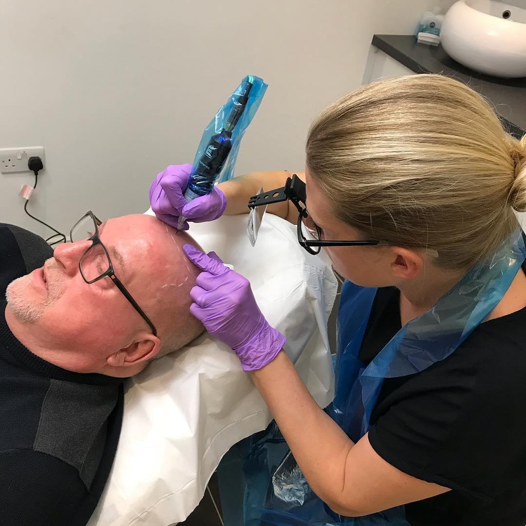What Is Scalp Micropigmentation? A Complete Beginner's Guide