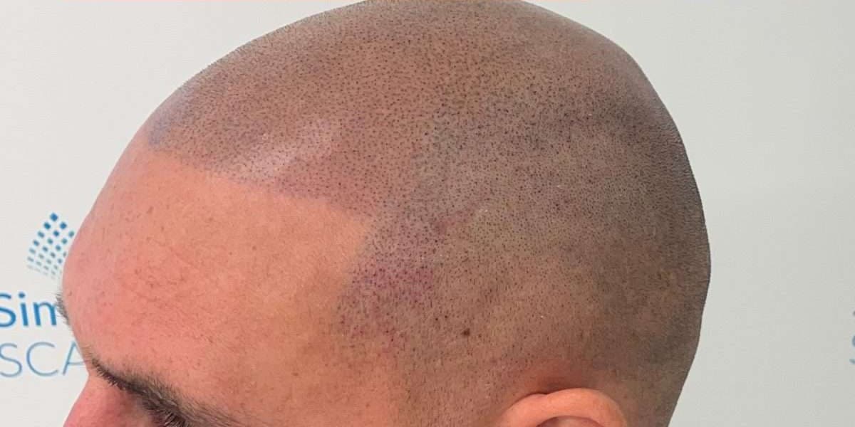 Client scalp during scalp micropigmentation treatment