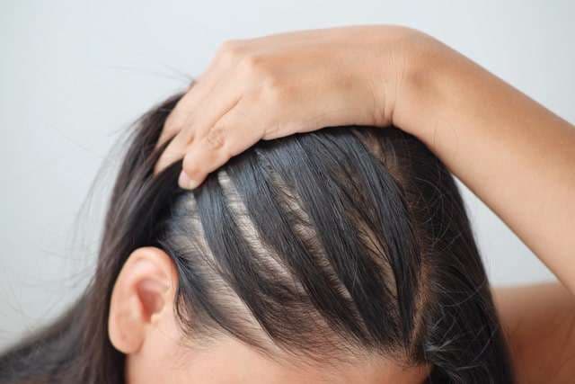 Scalp micropigmentation for alopecia at Simply Scalp