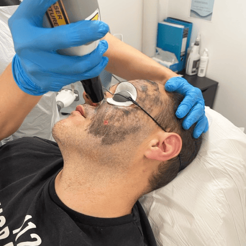 Carbon facial treatment at Simply Scalp