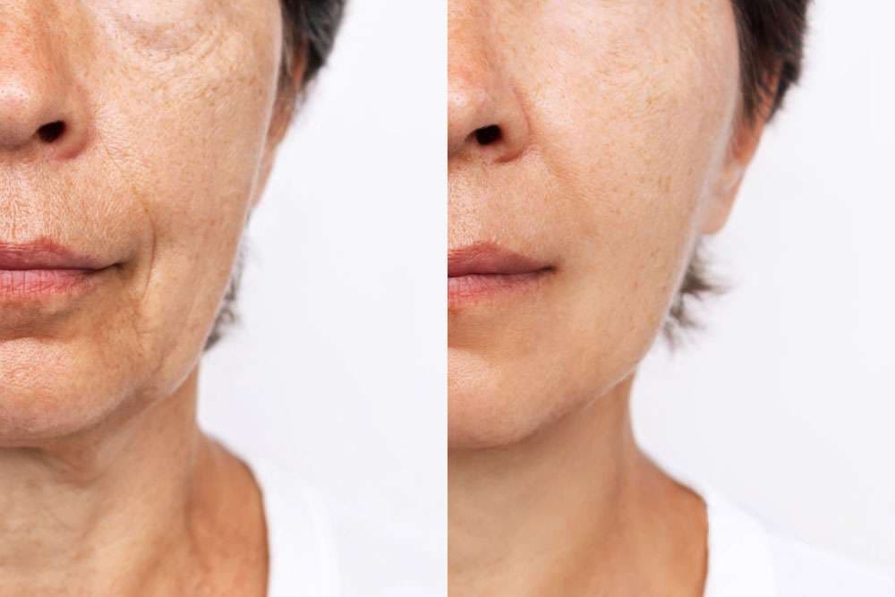 Skin before and after microneedling treatment