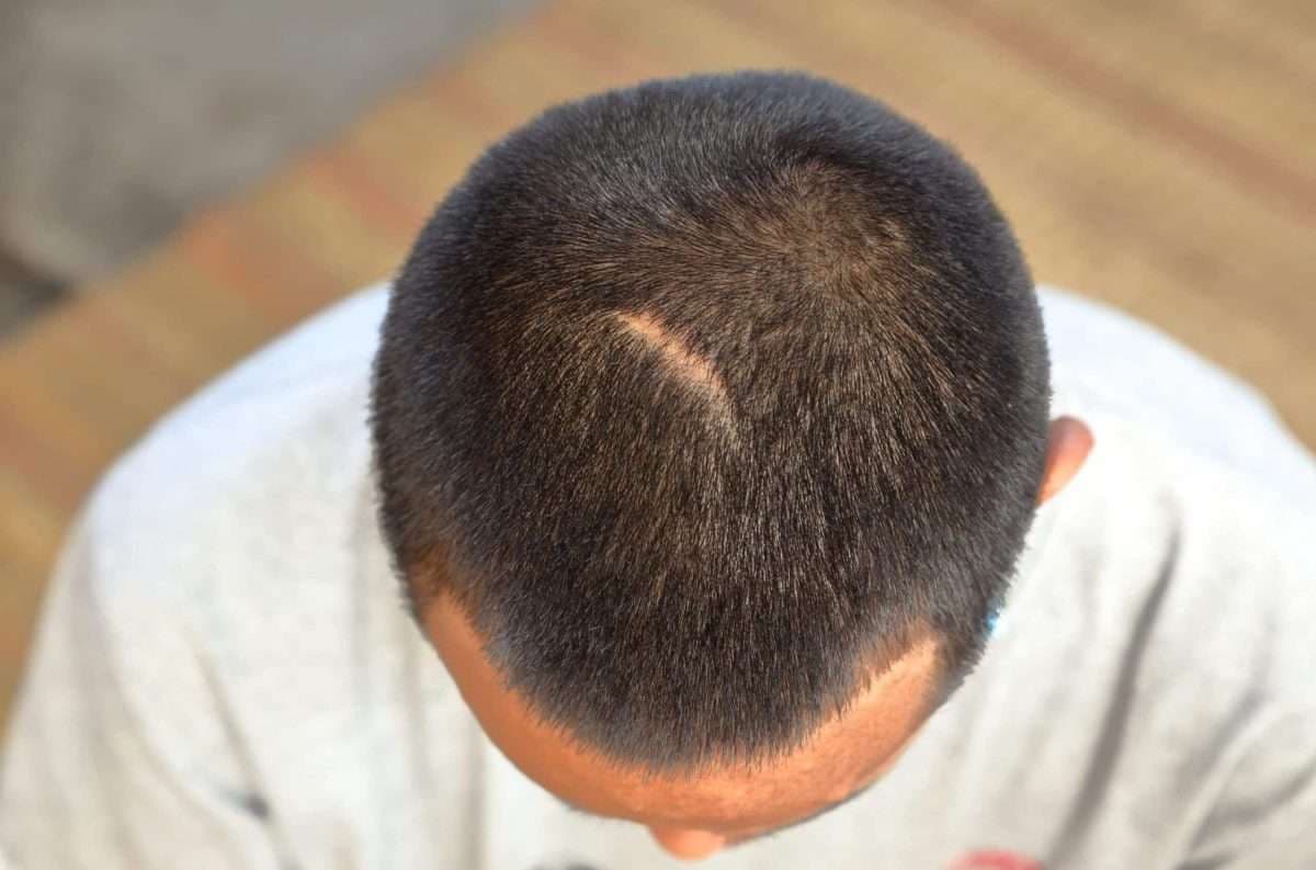 Scar camouflage with scalp micropigmentation at Simply Scalp