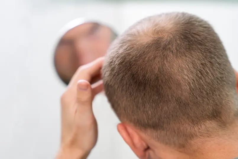 Factors That Influence How Your Treatment Progresses — scalp micropigmentation at Simply Scalp