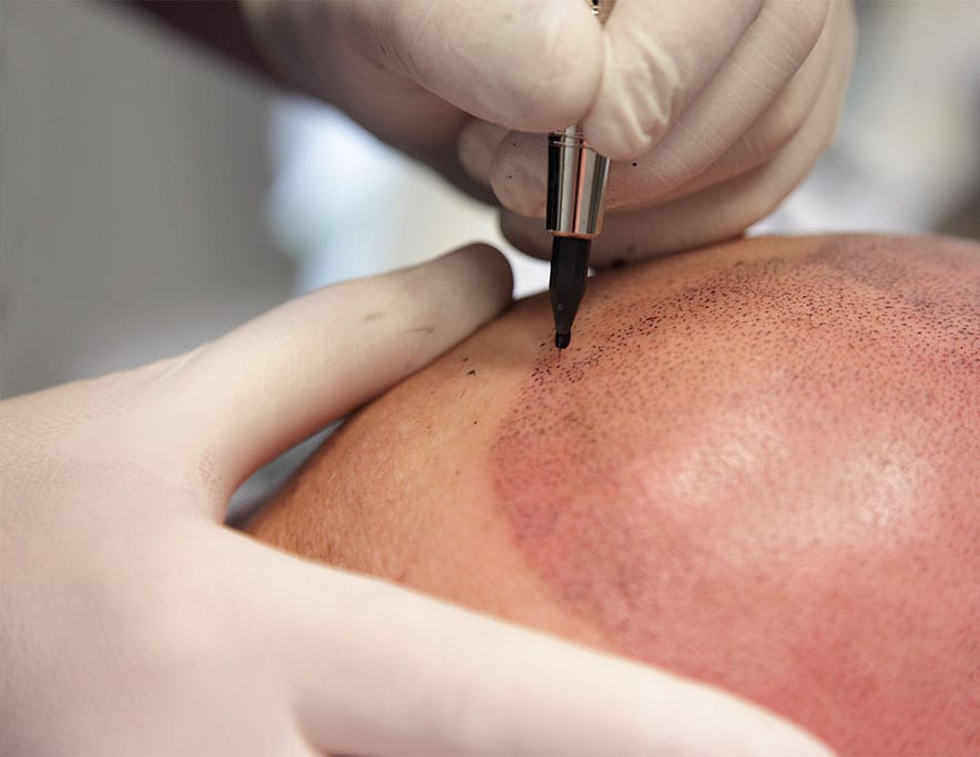 What About Touch-Ups After the Initial Treatment — scalp micropigmentation at Simply Scalp