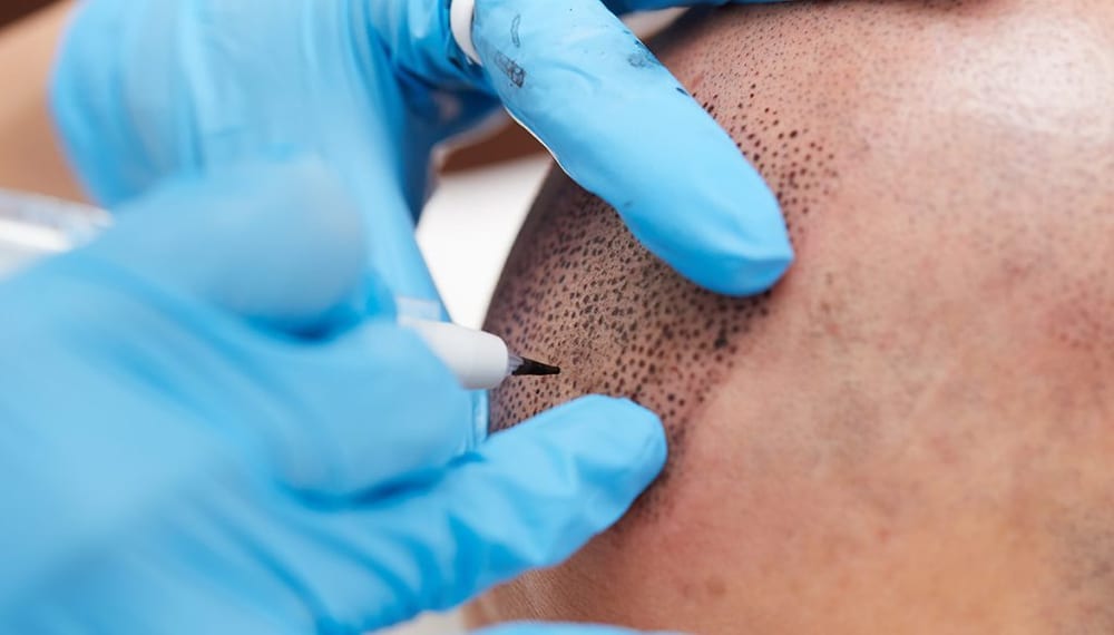 What Actually Happens During a Session — scalp micropigmentation at Simply Scalp