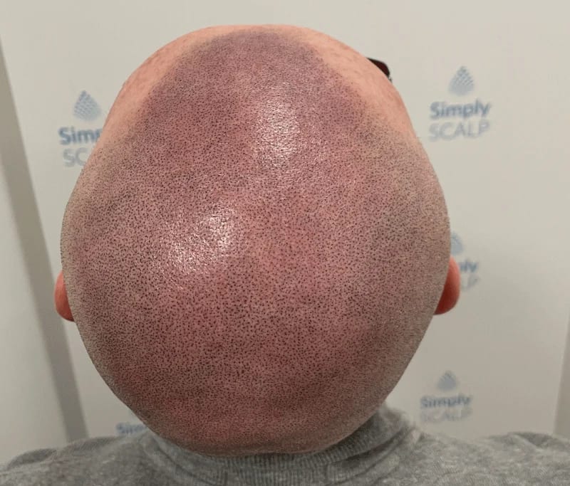 What to Expect After Each Session — scalp micropigmentation at Simply Scalp