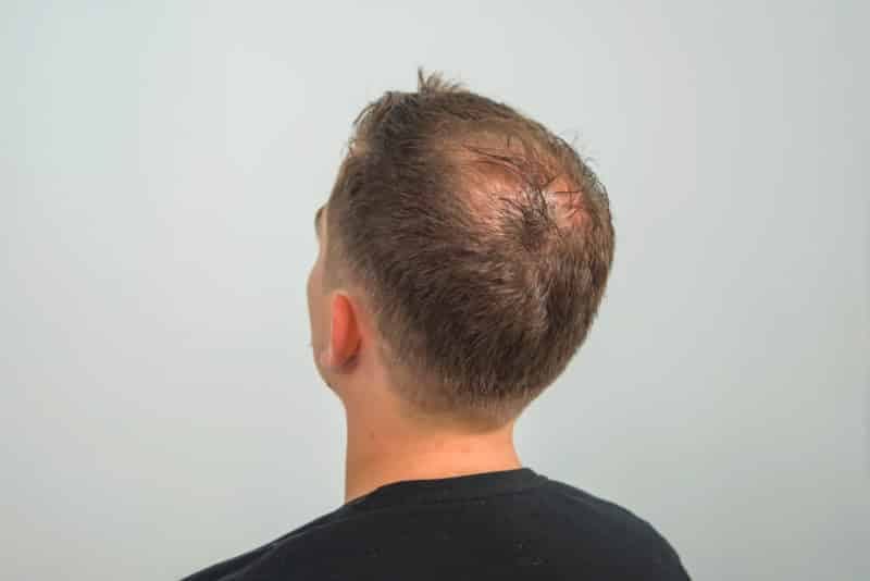 Cost Comparison: SMP vs. Hair Transplant — scalp micropigmentation at Simply Scalp