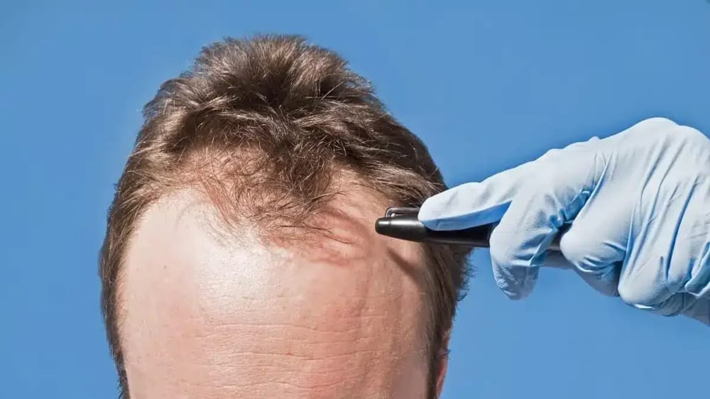 Session One: Laying the Foundation — scalp micropigmentation at Simply Scalp