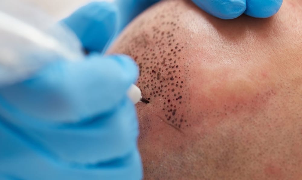 What Happens Between Sessions — scalp micropigmentation at Simply Scalp