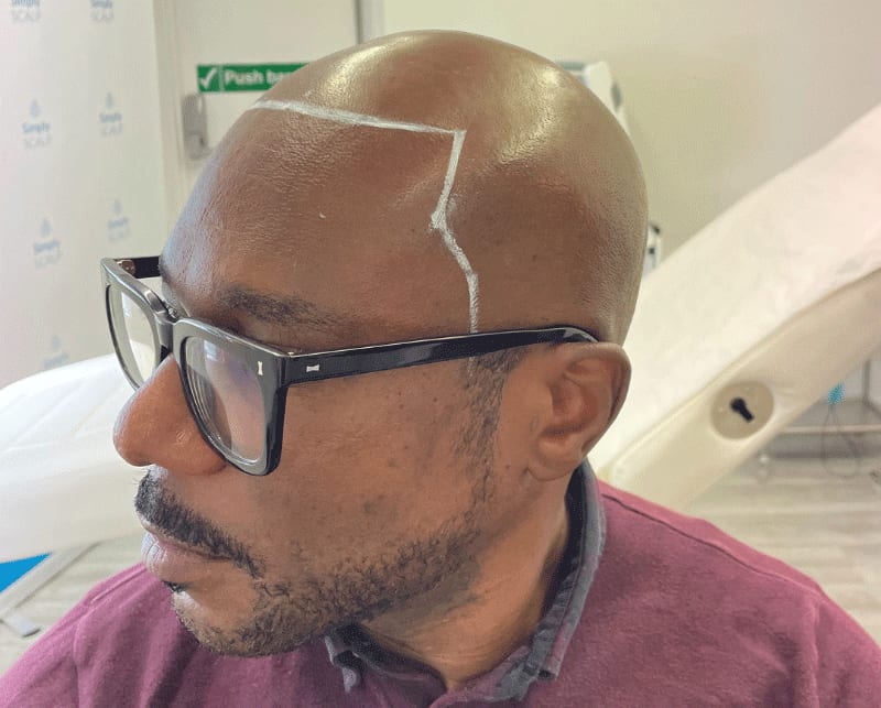 What Can You Expect From the Process — scalp micropigmentation at Simply Scalp