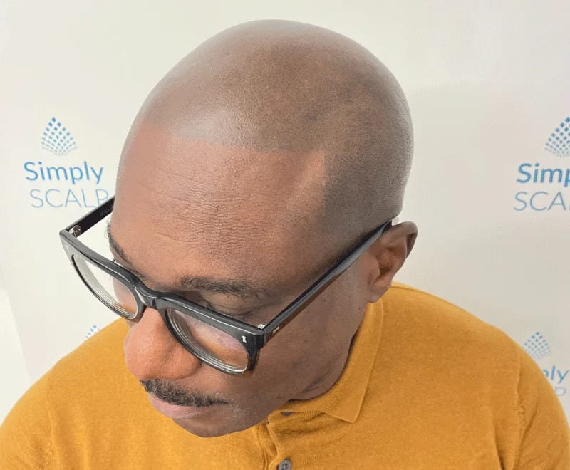 What Do SMP Results Look Like — scalp micropigmentation at Simply Scalp